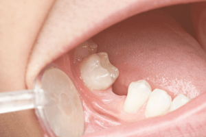 GSD-BLOG-Bone-Grafting-Dental-Implants-Cosmetic-Dentist-BLOG-02.08.21