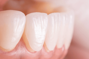 Teeth Repair cracked or worn teet 