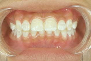 GSD-BLOG-White-Spots-On-Teeth-Causes-Treatment-Prevention-07.29.21