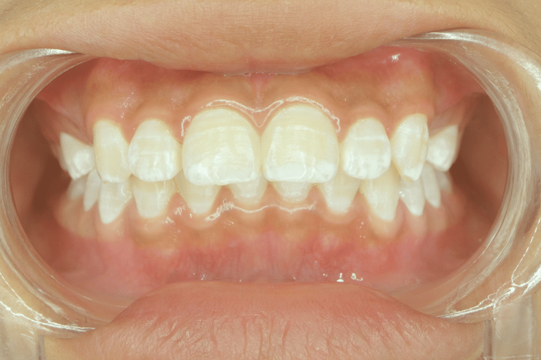 White Spots On Teeth Causes Treatment And Prevention