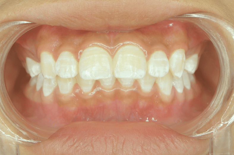 White Spots on Teeth Causes, Treatment, and Prevention