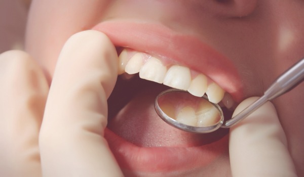 GSD-Composite-Fillings-Better-Alternative-to-Amalgam-BLOG-04.25.24 (1)
