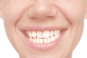GSD-Crooked-Teeth-Causes-Risks-Treatment-Invisalign-Blog