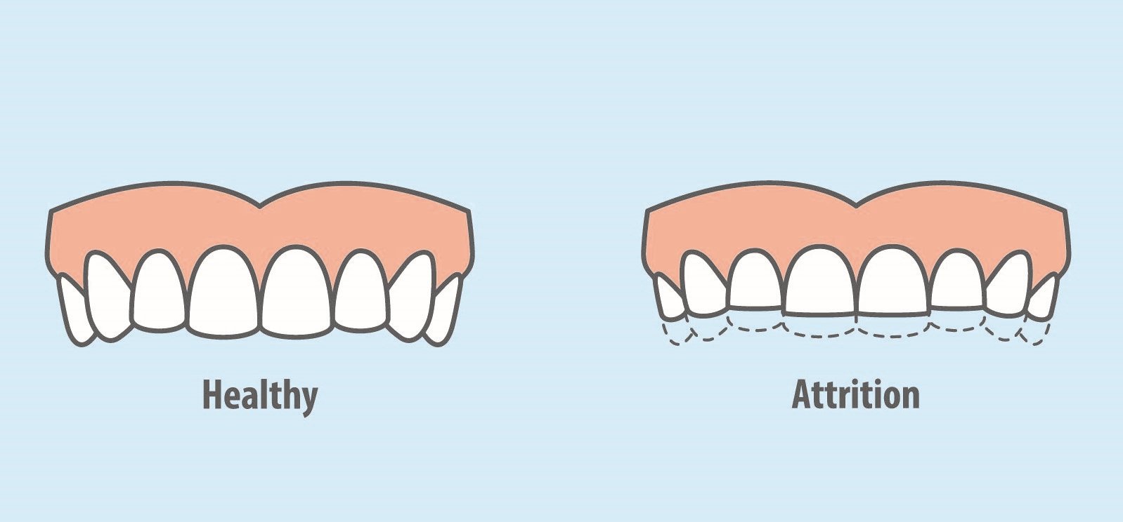 3 Cosmetic Procedures to Repair Tooth Grinding Damage