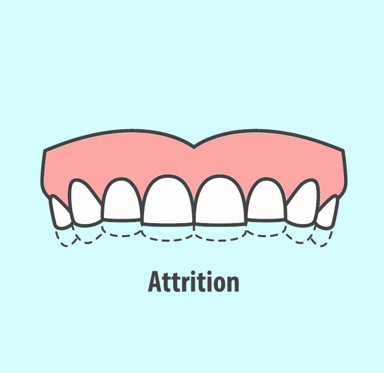 What is Dental Attrition?