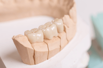 GSD-Dental-Bridges-Alternative-to-Dental-Implants-Blog