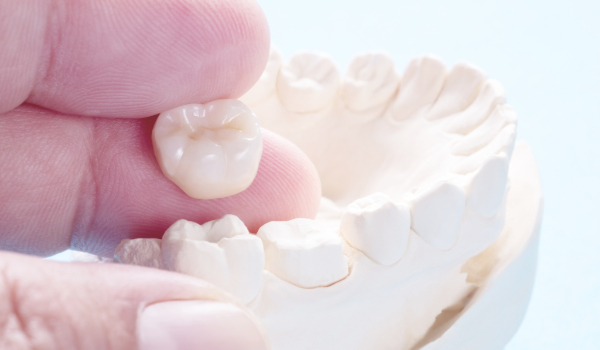 GSD-Dental-Crowns-Everything-You-Need-To-Know-04.12.24BLOG