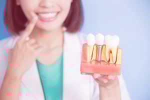 GSD-Dental-Implants-Everything-You-Need-To-Know-Blog