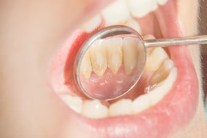 GSD-Dental-Tartar-Plaque-Calculus-Causes-Prevention-Removal-Blog-10.15.20-2