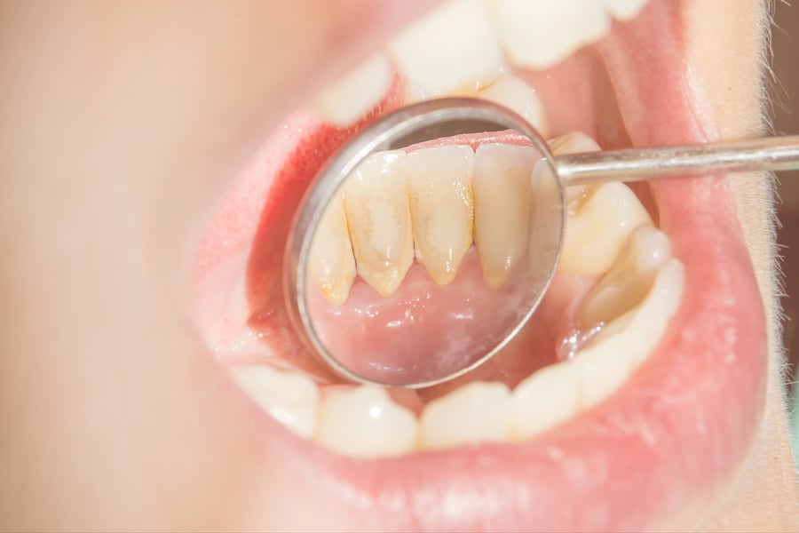 Dental Tartar (Calculus) Causes, Prevention and Removal
