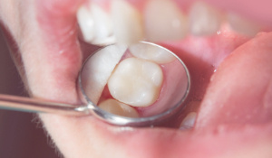GSD-Onlays-vs-Fillings-05.18.24-3 (1)