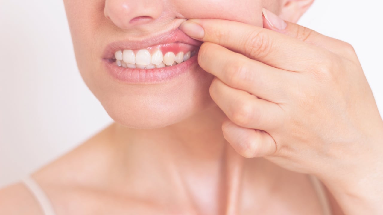 GSD-Periodontal-Gum-Disease-Everything-to-Know-02.10.25-2