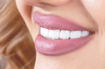 GSD-Reasons-to-Consider-Dental-Veneers-BLOG-02.16.23-1 (1)