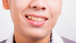 GSD-Tooth-Discoloration-Image
