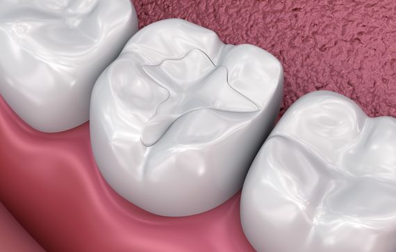 Fill Vs Inlay Filling, Inlay, Onlay, or Crown? What is the Difference?