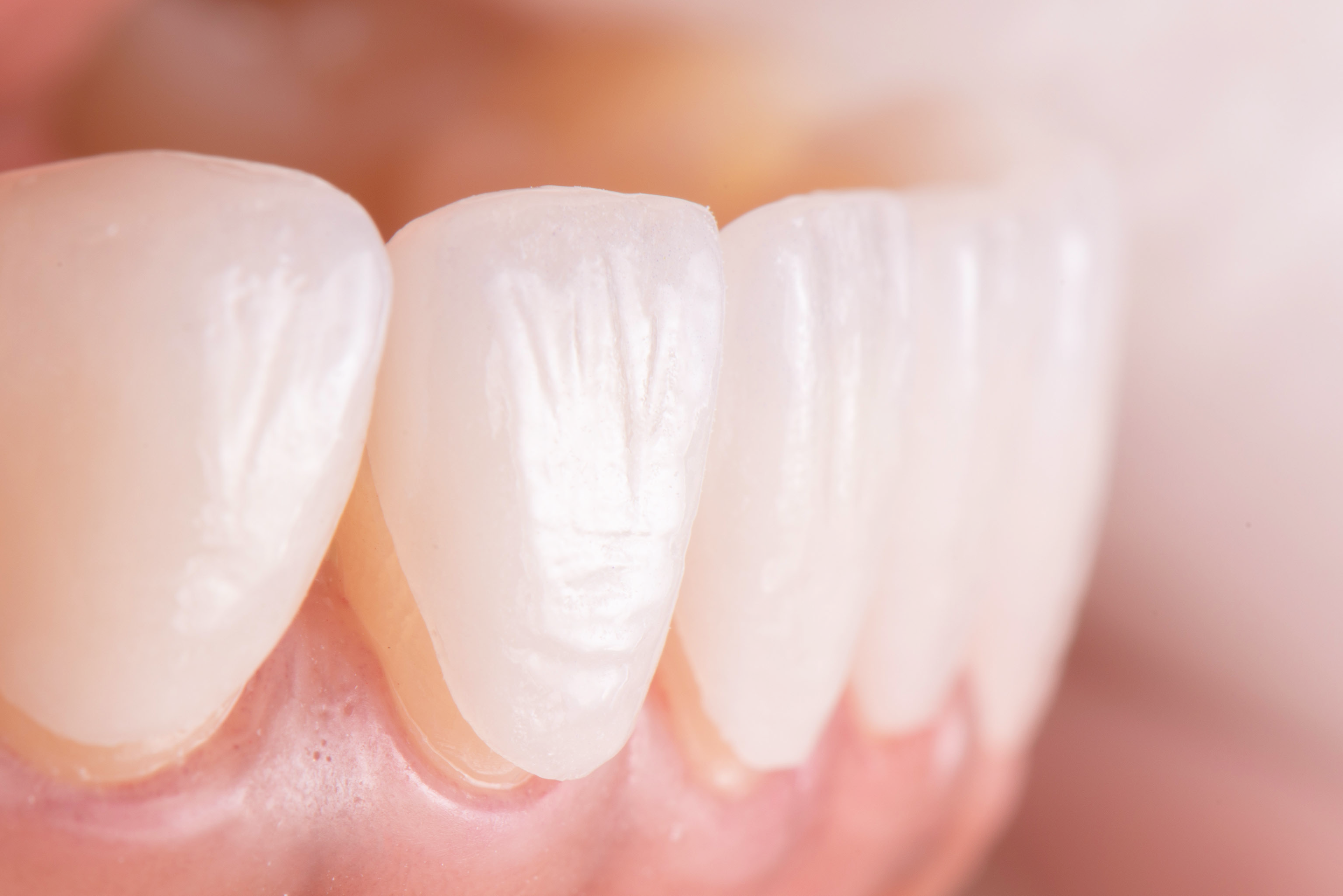 Cracked Tooth Repair and 5 Reasons to Visit a Cosmetic Dentist