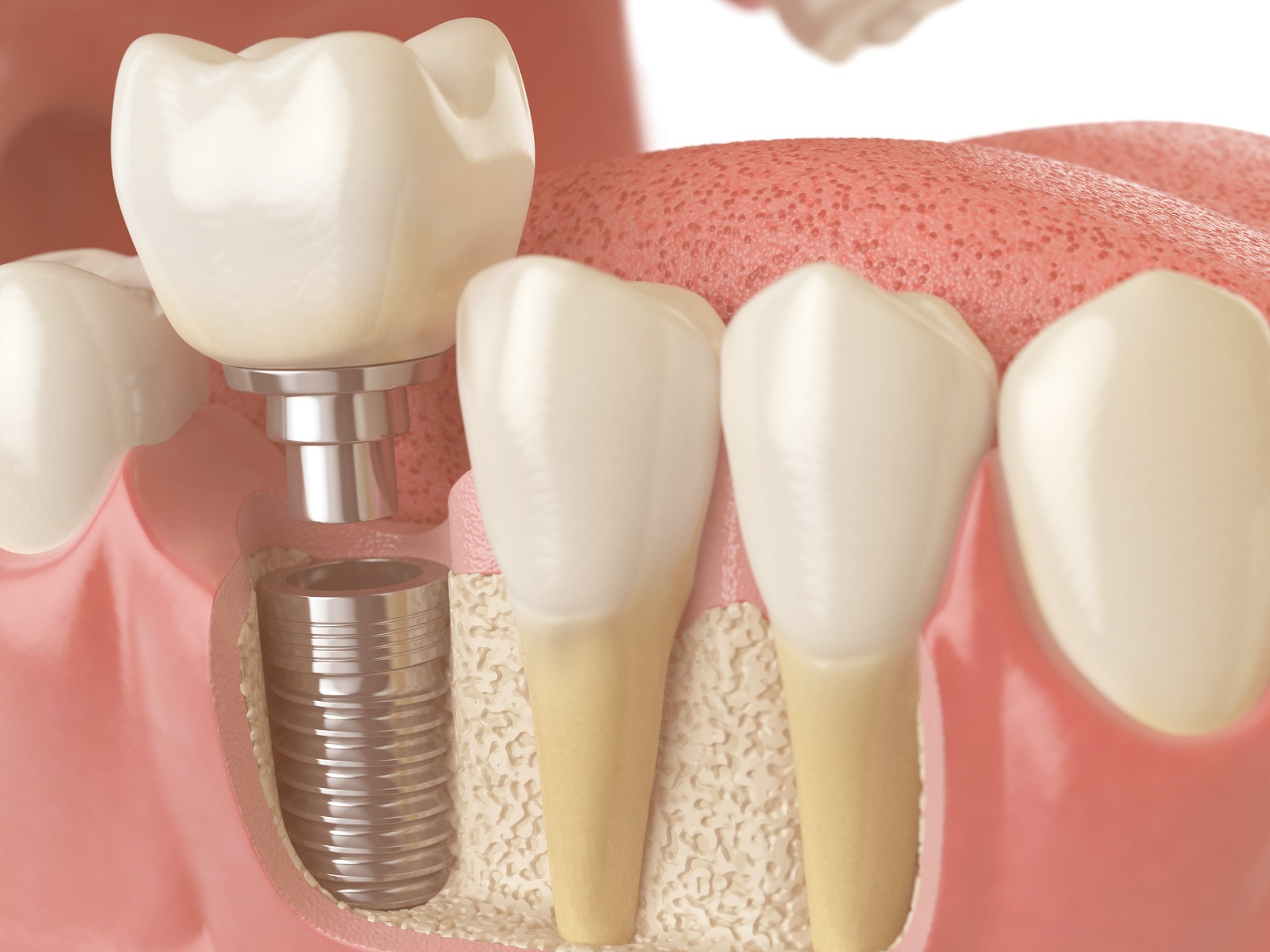 Bone Grafting For Dental Implants What Is It And How Does It Work