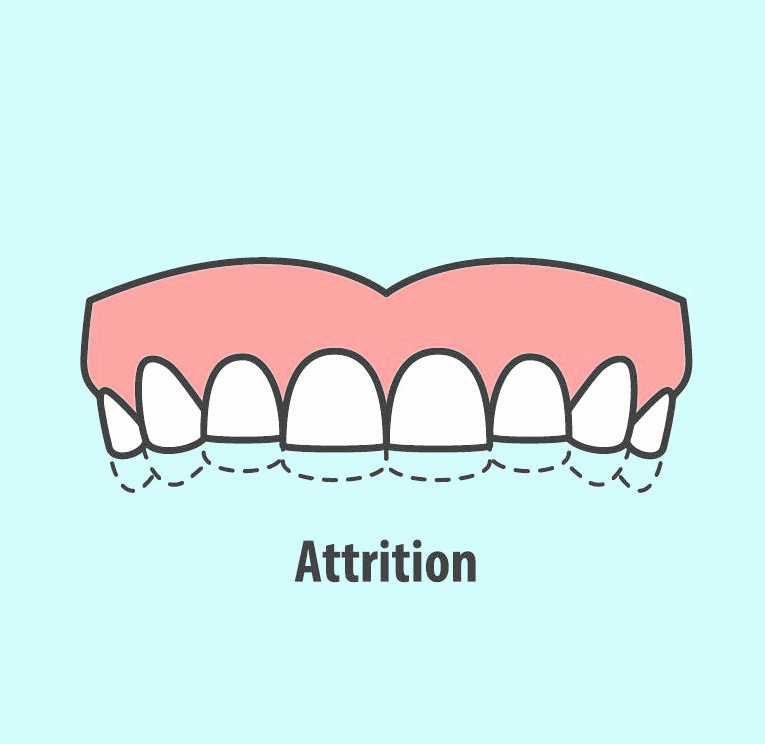 attrition