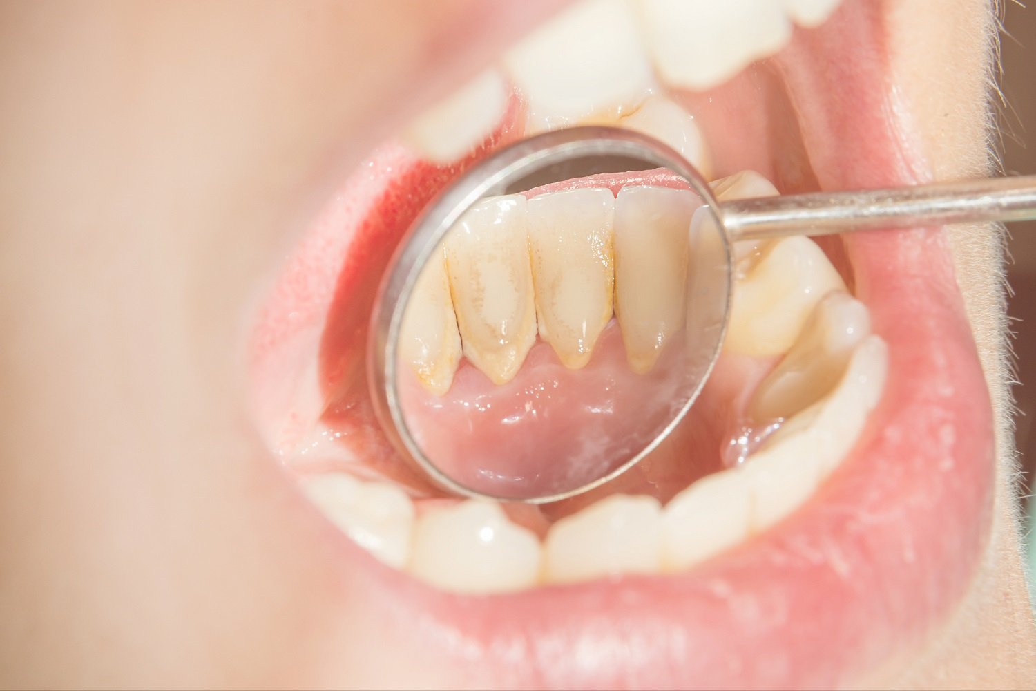 Tartar on Teeth (Dental Calculus): Causes & Removal