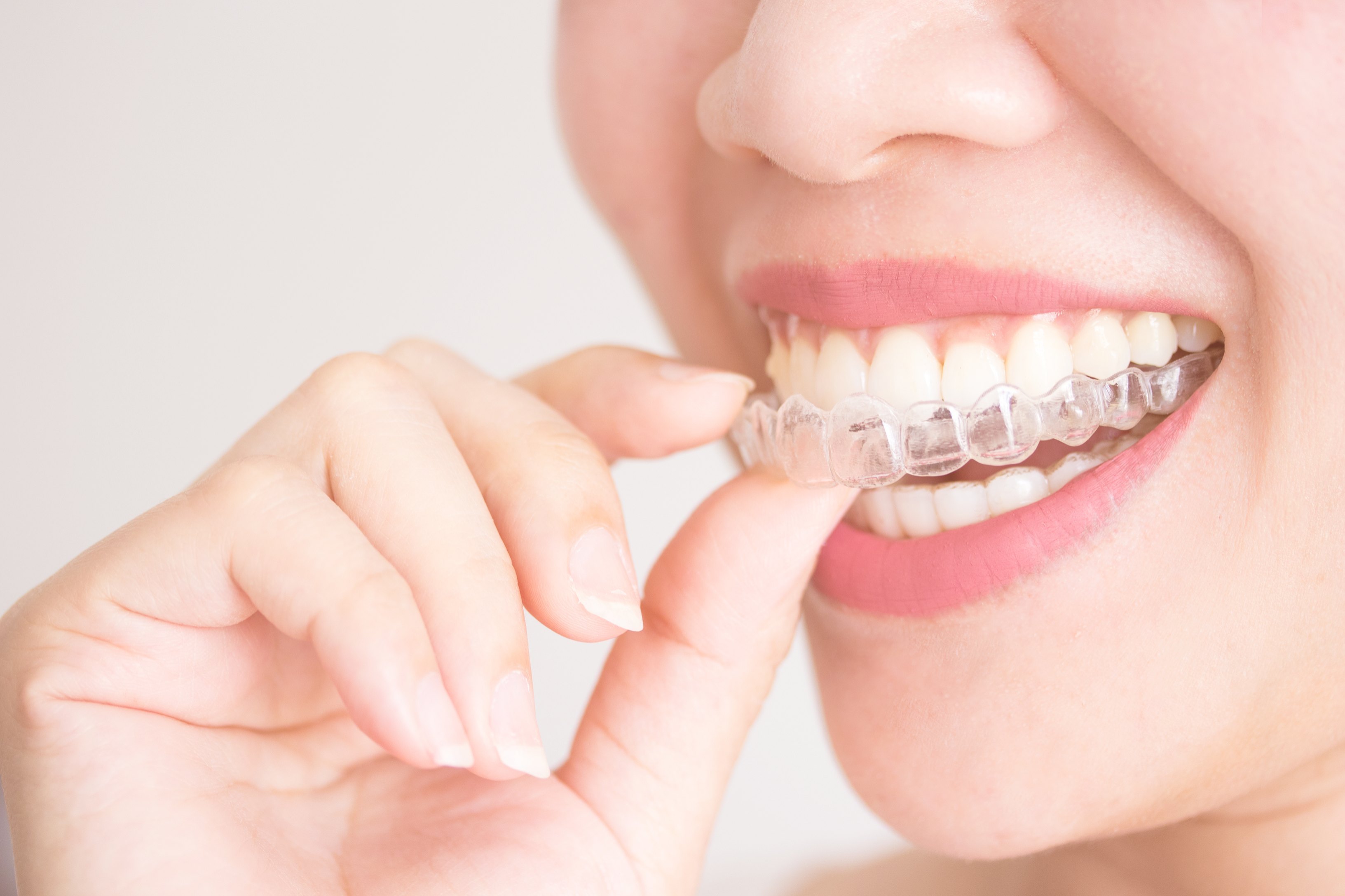 Straighten Your Teeth with Invisalign Clear Aligners