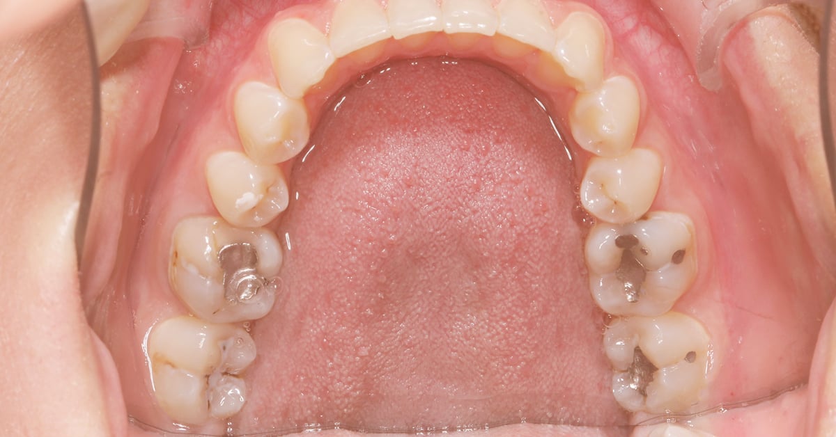 Composite VS Silver Fillings