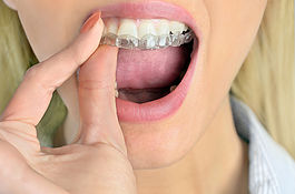 Dental attrition